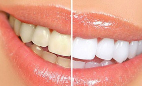 4 thắc mắc thường gặp khi tẩy trắng răng
